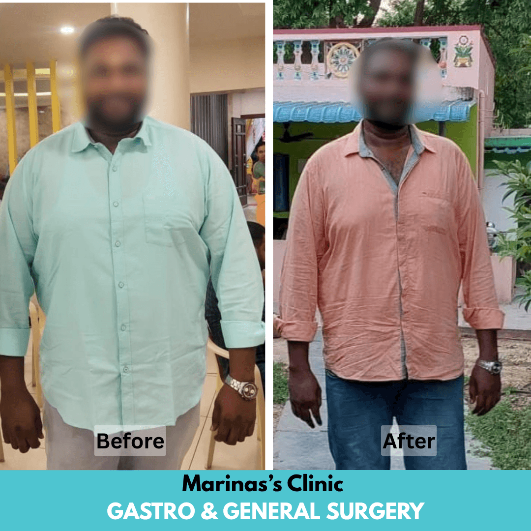 Male bariatric patient before and after bariatric treatment