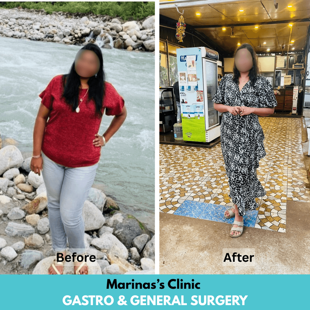 Female bariatric patient before and after bariatric treatment