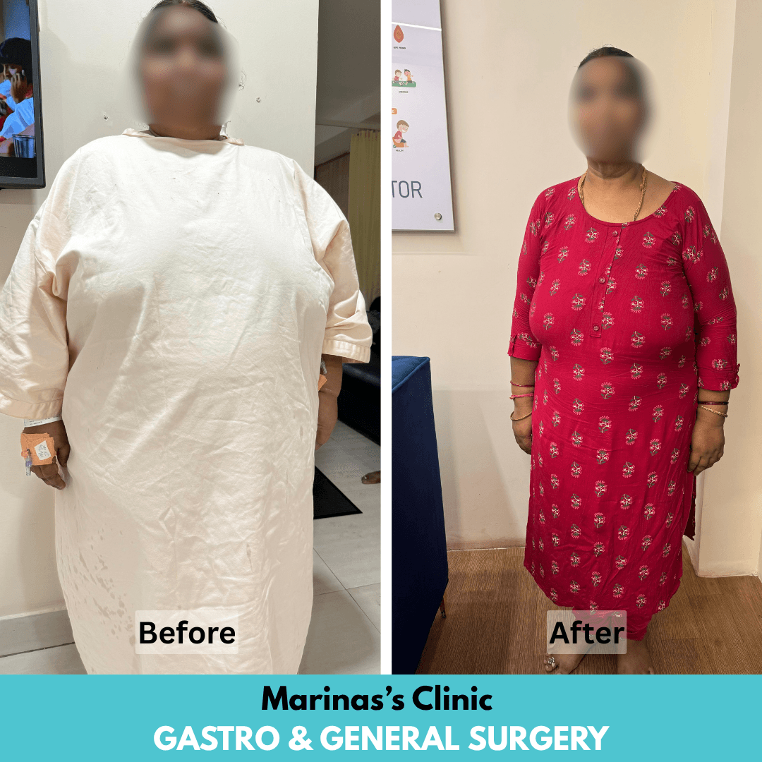 Female bariatric patient before and after bariatric treatment